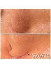 サラモ(Sa La Mo)/ハイドラフェイシャル