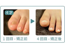 巻き爪研究所 表参道院/幼児やお子さんも矯正可能です