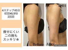 ハピネス(HAPPINESS)/4ステップメニュー　二の腕2回目