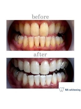 NA ホワイトニング 川崎溝の口店/ホワイトニング/川崎/溝の口