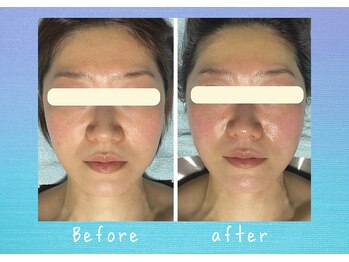 マタハリ(Matahari)/小顔コルギ