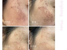 ドアディ(Doordie)/Brightingフォト　しみケア 