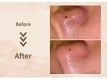 プラム(plum)/トルネード毛穴洗浄