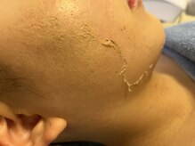 グリーンピールサロン ラニ(Lani)/不要角質が浮き上がってきました