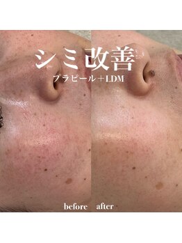 イロハ(IROHA)/シミ改善!