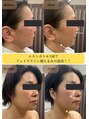 ティー(T)&nbsp;レモンボトル！1回でお肌リフトアップ☆