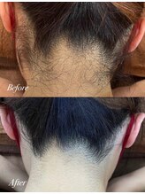 ジューンブライド(June Bride 61)/えりあし脱毛