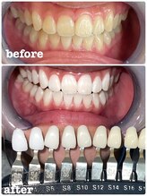 アミュホワイトニング/医療提携ホワイトニング