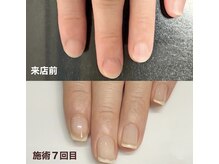 ポノポ(ponopo)の雰囲気(生まれつきこの爪の形。と諦めてた50代 H様)