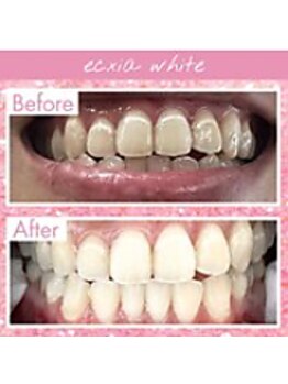 エクシアホワイトニング 中野駅北口店/ホワイトニングビフォーアフター