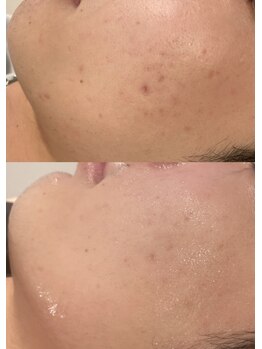 ベル(belle)/韓国肌プログラムピーリング