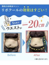 エステティック らぽーる(Rapport)/脂肪冷却！
