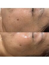 ヨルエステ(yoru aesthe)/【エイジングケア】