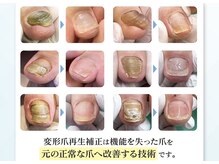 巻き爪補正店 鹿児島店の雰囲気（変形爪再生補正 : 専門店ならではのメニューとなります）
