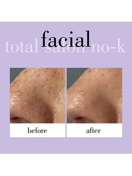 ヌック(NO-K)/光フェイシャル