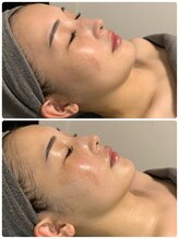 ラグ(LUXU)/超小顔術バンテージ