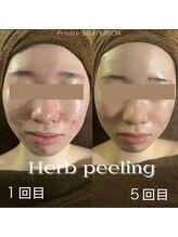 カヨン 新所沢店(KAYON)/ハーブピーリング Before→After