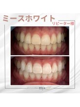 ミースホワイトニング(mys whitening)/ビフォーアフター【歯科提携】