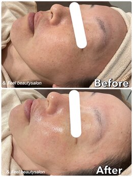 エンフィール(&.Feel)/大人毛穴ハリツヤ変化★