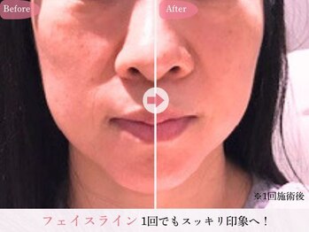 リジェネラティブセル メディカルサロン(Regenerative Cell Medical Salon)の写真/1回の施術で小顔へ！引き締まったフェイスラインに◎リフトアップを実感♪