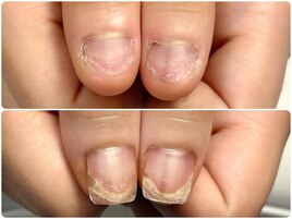 深爪解消♪自爪風長さだし