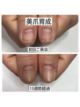 マニュコクーン(ManuCocoon)/爪育成　深爪　巻き爪　大阪市