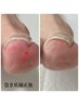 【フット】巻き爪補正（1本）