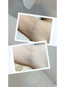 ネクサス(NEXUS)/5ヶ月でこの変化！