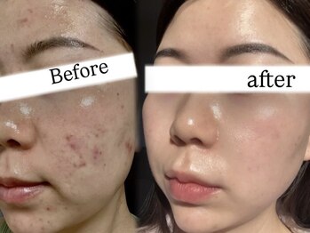 ラメール(la mer)/痩身/眉毛/エステ/フェイシャル