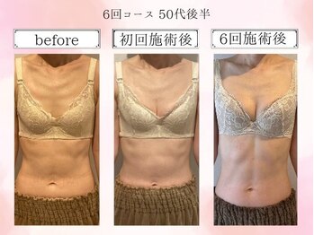 リール 恵比寿店(RIRE)/バストアップ症例【広尾恵比寿】