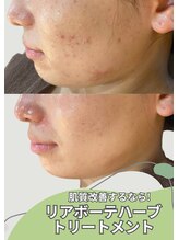 ミオ(MIO) 肌質改善 健康素肌