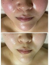 マリエンドリー/小顔＆きめを整えたい