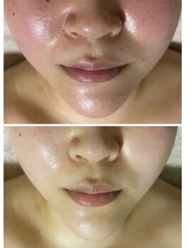 マリエンドリー/小顔＆きめを整えたい