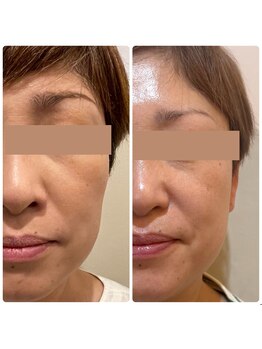 【医療提携】毛穴・たるみ・美肌育成専門店　緒々one＋【チョチョワンプラス】/目元のたるみほうれい線に