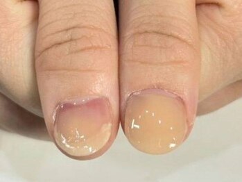 深爪矯正専門店 サロン・ド・コロレの写真/《メンズOK/バレない美爪》コンプレックスを魅力へチェンジ★速攻ケアでスラっと縦長フォルムを実現!