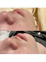 コモレビ(komorebi)/口周りの産毛もスッキリオフ♪