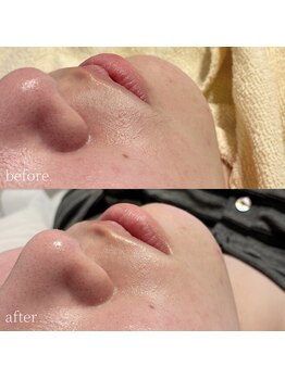 コモレビ(komorebi)/口周りの産毛もスッキリオフ♪