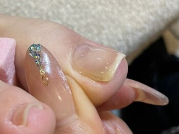 サロン ド ワカ(Salon de WAKA)/巻爪改善　after