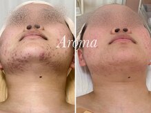 アロマ(AROMA)/あごニキビケア　(2)