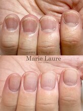 マリーロール 梅田店(Marie Laure)/自爪育成/深爪矯正/ネイルケア