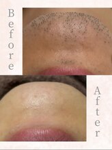 美肌脱毛専門店 パールプラス 大在店/メンズヒゲ脱毛