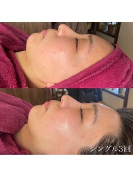 小顔フェイスラボ 鈴鹿店(小顔FaceLabo.)/◆肌質改善◆