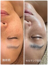 リノ(LINO)/フェイシャルケア“セルマン”