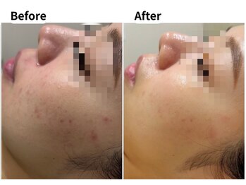 ムーロ バイ ミュー(muro. by mieux)/Before After