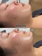 アザレア(Azalea)/マイクロウェーブリフト/恵比寿