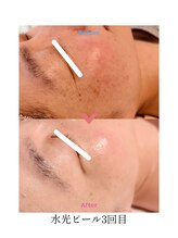 エテル(eter)/40代女性水光ピール３回目