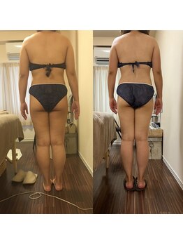 グラン ジュテ/筋膜ラジオ波ンドとMキューブ