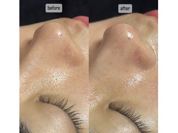 スピカ(Spica)/施術1回毛穴エクストラクション