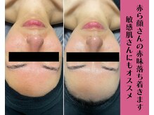 ヴィータ(VITA)/陶肌トリートメント