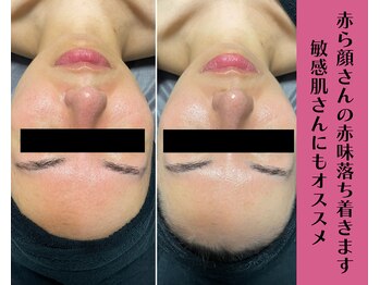 ヴィータ(VITA)/陶肌トリートメント